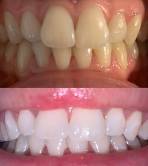 Blanchiment dentaire